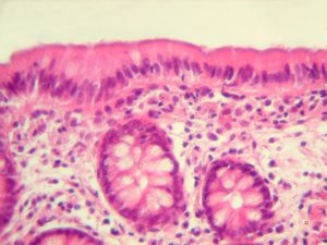 F,52y. | spirochetosis … colon (HE) … blue-stained brush border F,52y. | spirochetosis … colon (HE) … blue-stained brush border